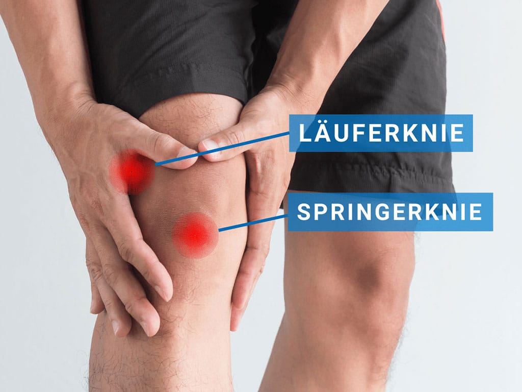 Sportler mit Knieproblemen Läuferknie vs. Springerknie