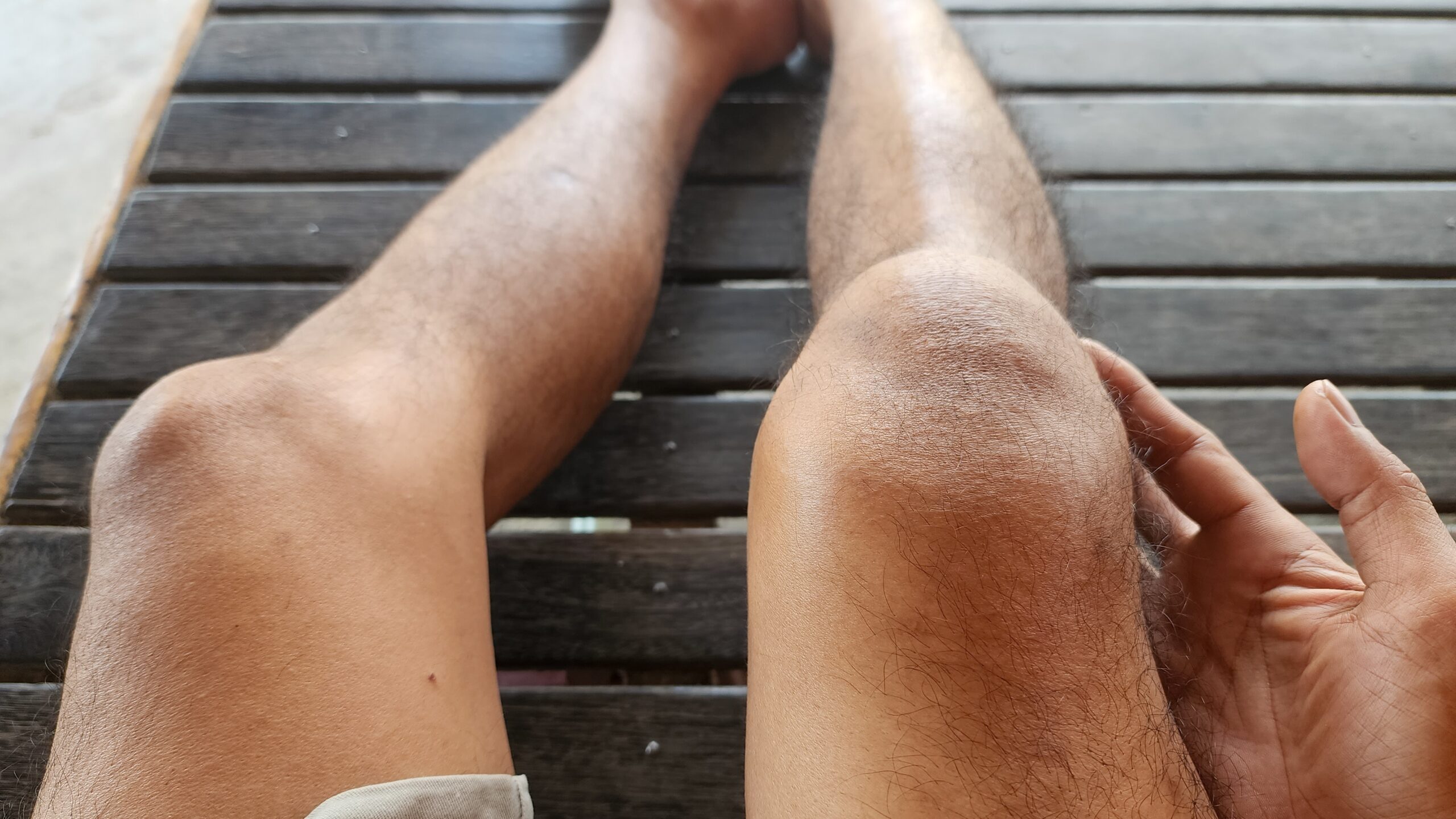 Schwellung im Knie durch Patellaluxation - Herausgesprungene Kniescheibe