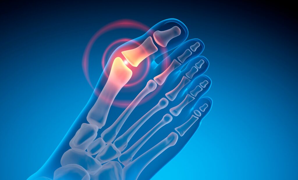 Hallux valgus - MEDIVID
